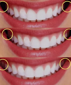 適當角度的咬合平面