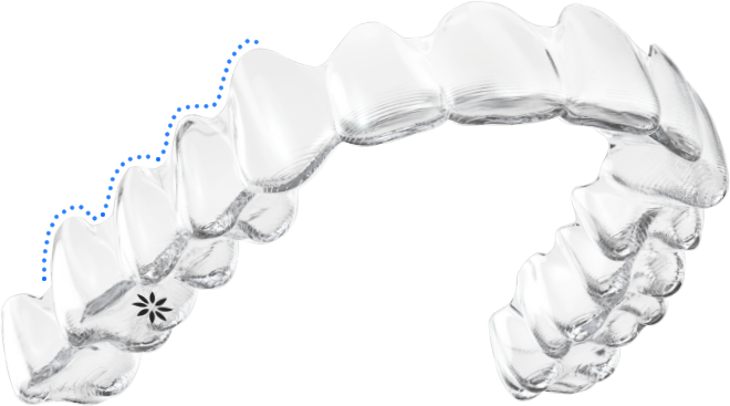 隱適美（Invisalign）裝置