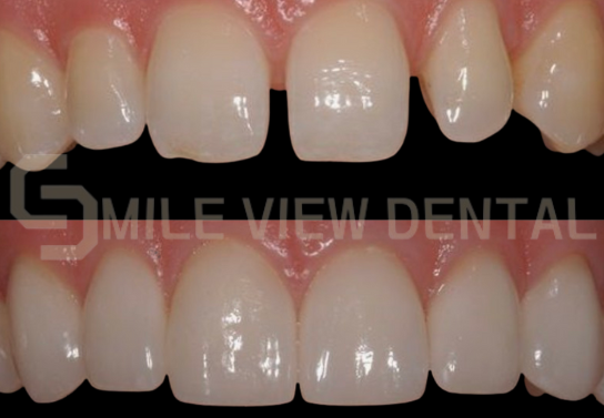 牙齒貼片療程案例1