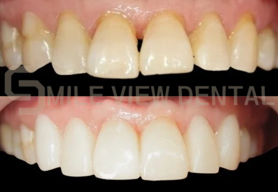 牙齒貼片療程案例2