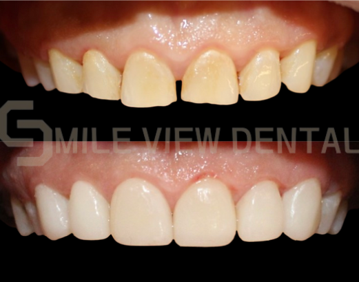 牙齒貼片療程案例3