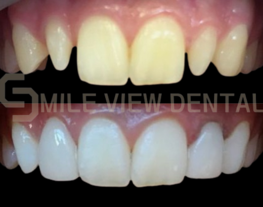 牙齒貼片療程案例4
