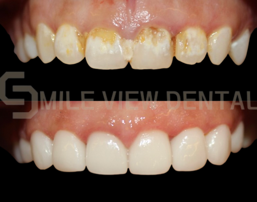 牙齒貼片療程案例5