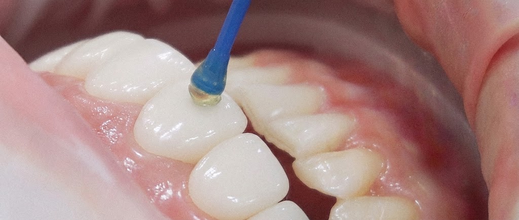 專業牙齒貼片療程流程