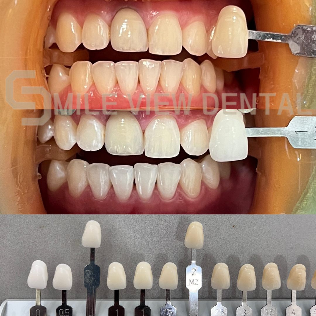 歯のホワイトニング施術前後1