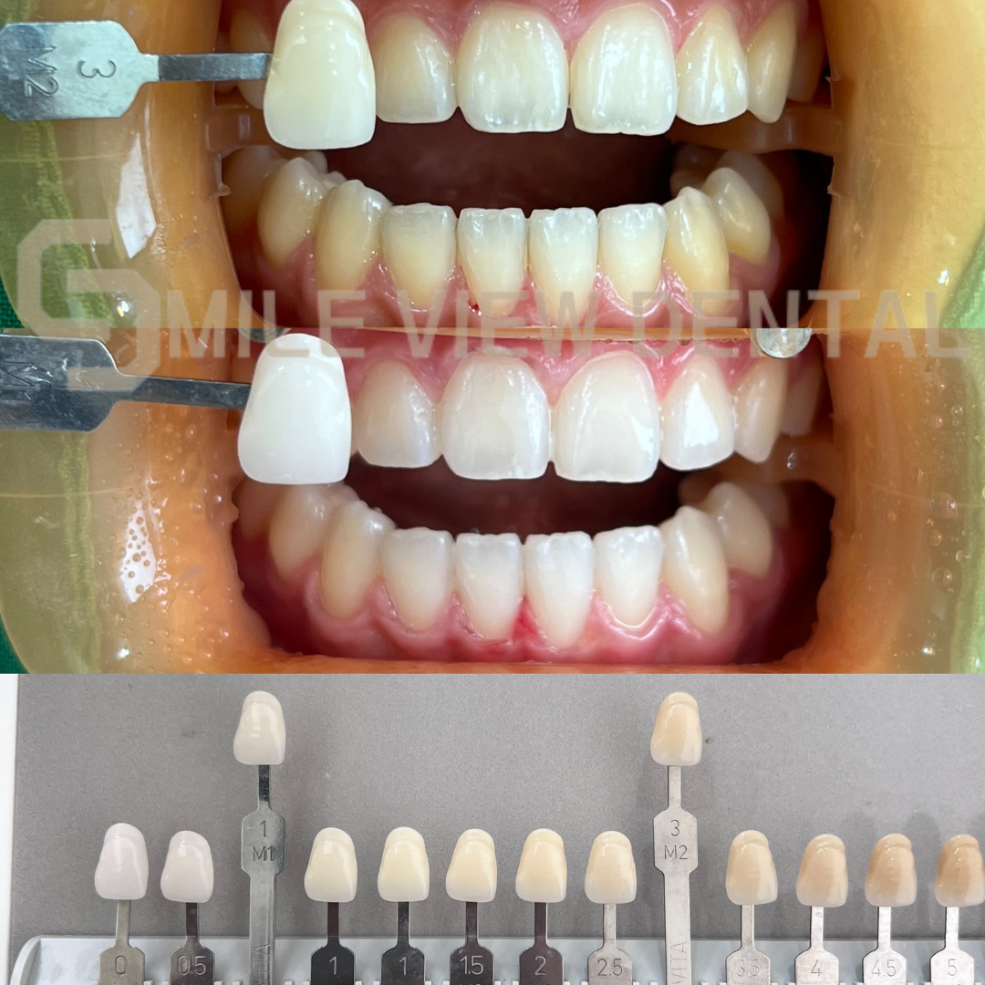 歯のホワイトニング施術前後2