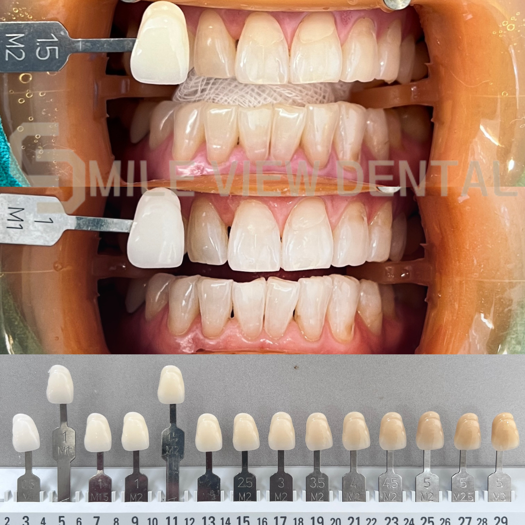 歯のホワイトニング施術前後3