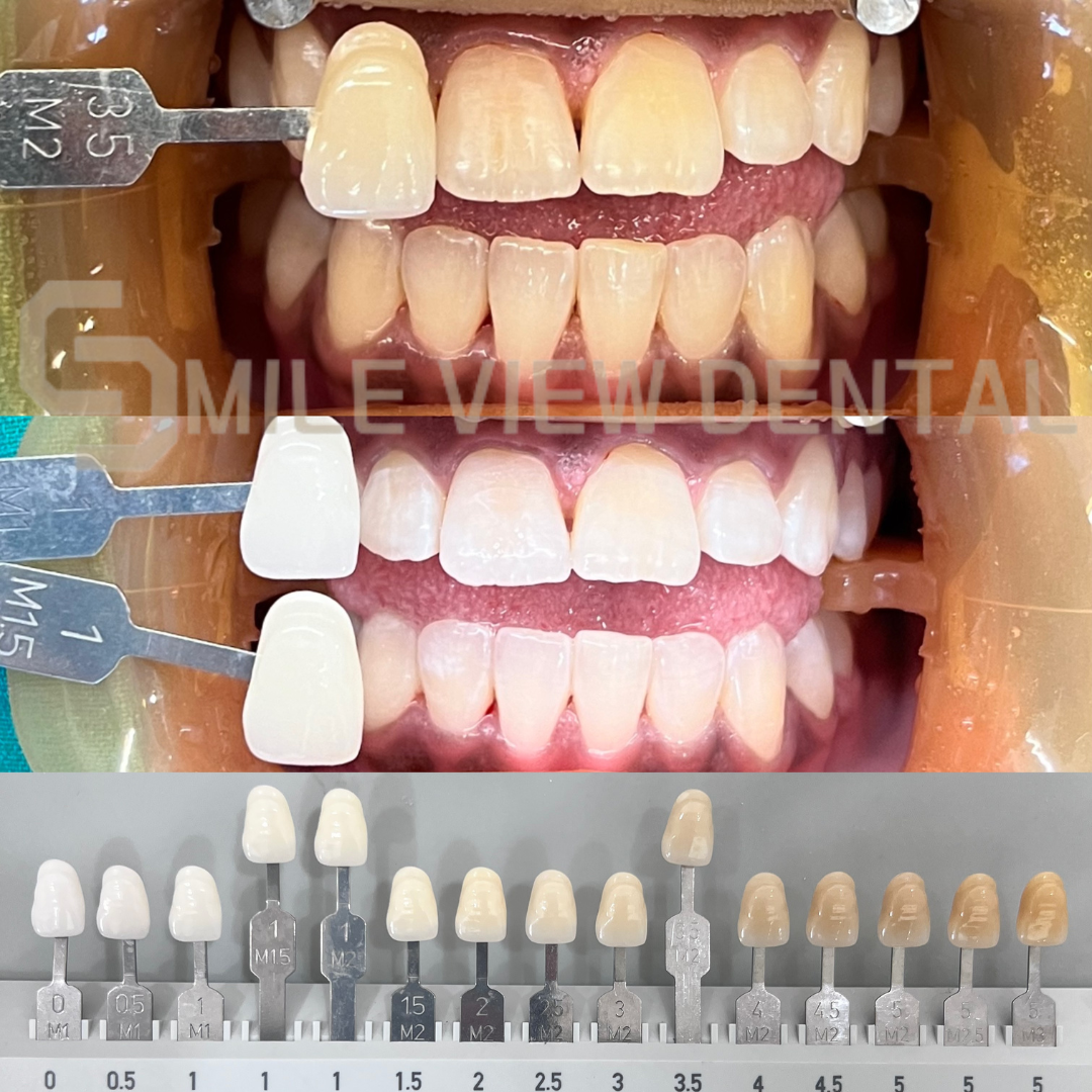 歯のホワイトニング施術前後4