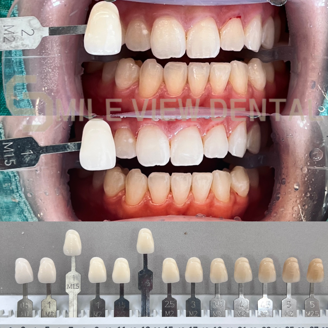 歯のホワイトニング施術前後5