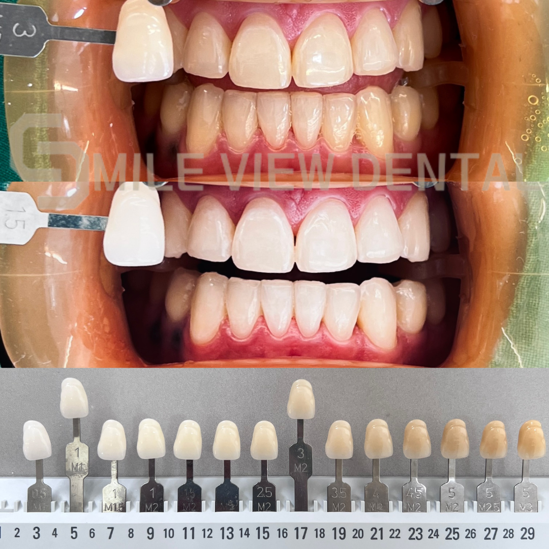 歯のホワイトニング施術前後6
