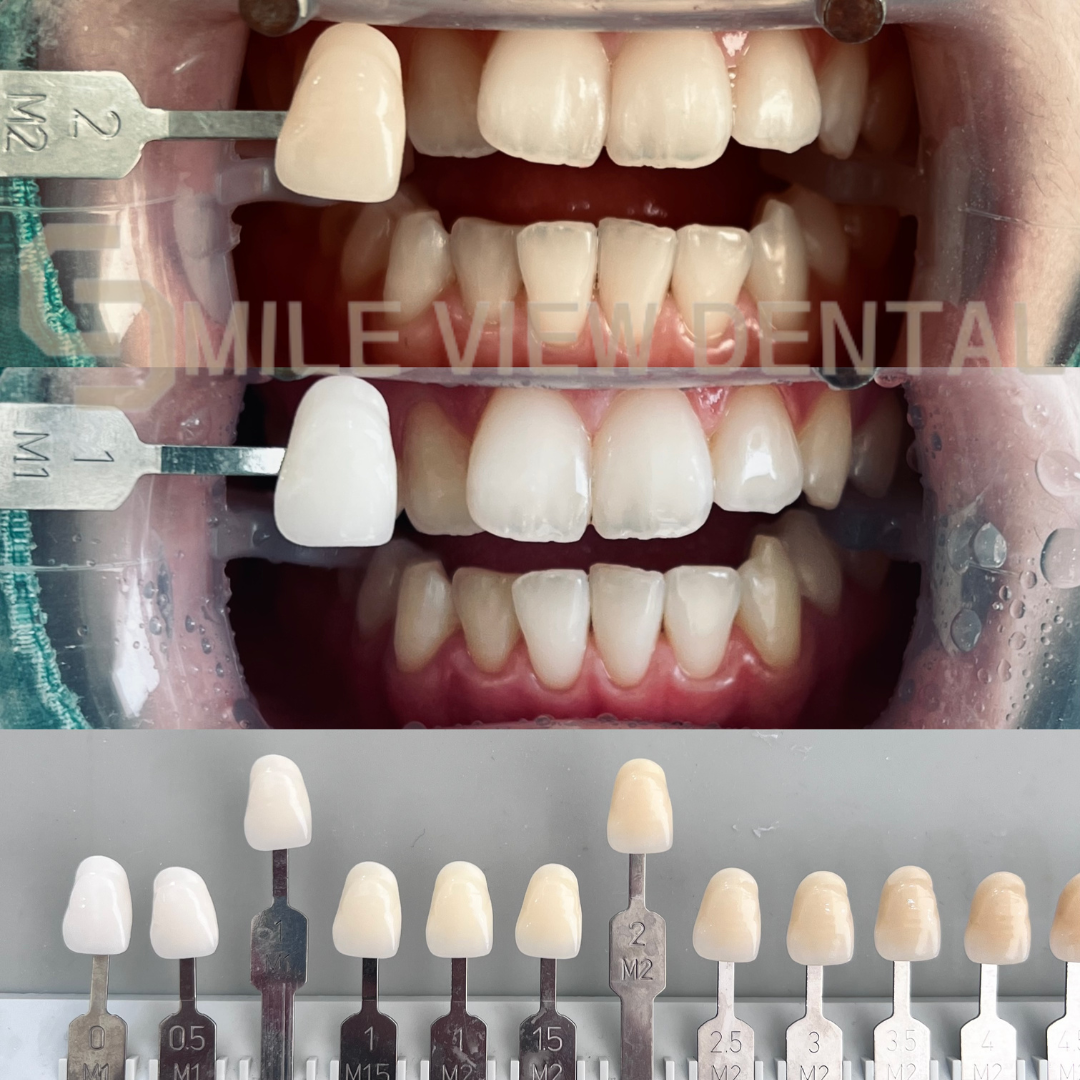 歯のホワイトニング施術前後7