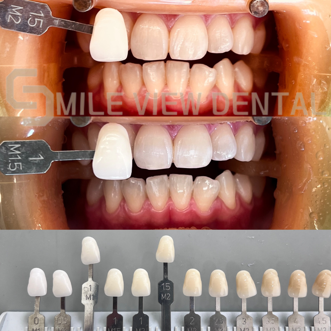 歯のホワイトニング施術前後8