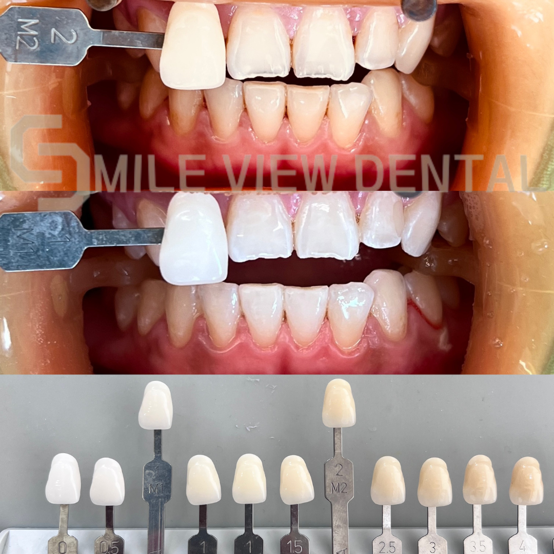 歯のホワイトニング施術前後9